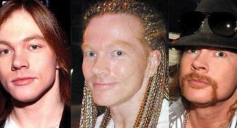 Axl Rose Plastic Surgery