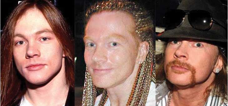 Axl Rose Plastic Surgery Before and After 2023