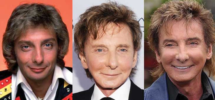 barry manilow plastic surgery