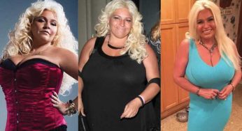 Beth Chapman Plastic Surgery