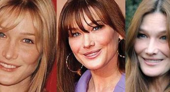 Carla Bruni Plastic Surgery