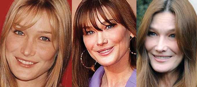 Carla Bruni Plastic Surgery Before and After 2023