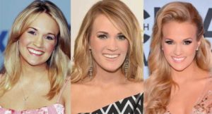 carrie underwood plastic surgery