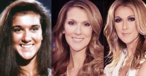 celine dion plastic surgery