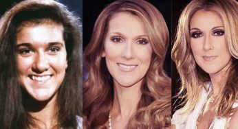 Celine Dion Plastic Surgery