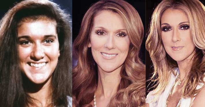 Celine Dion Plastic Surgery Before and After 2022