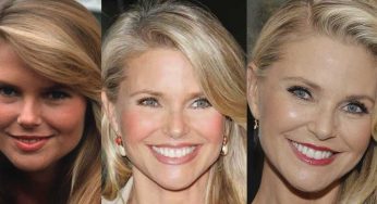 Christie Brinkley Plastic Surgery