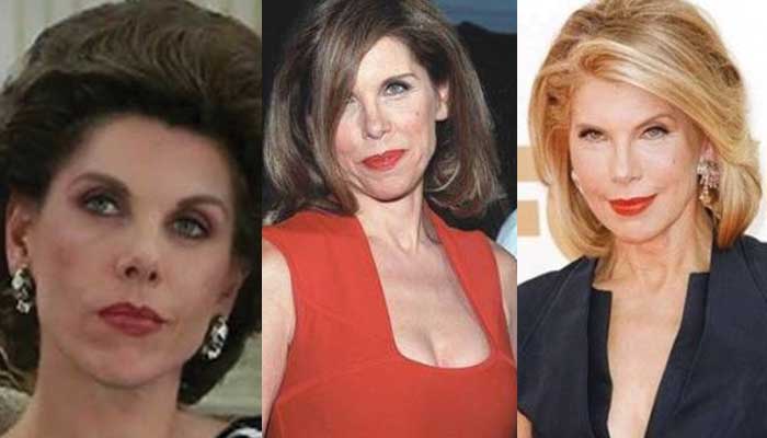 Christine Baranski Plastic Surgery Before and After 2022