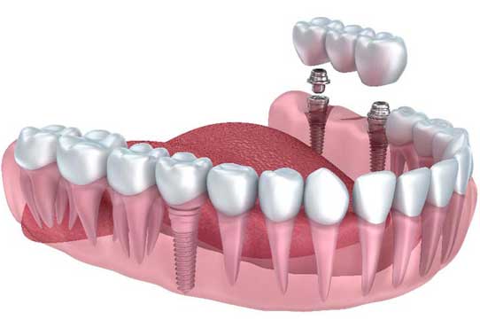 dental implant cost in usa