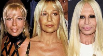 Donatella Versace Plastic Surgery