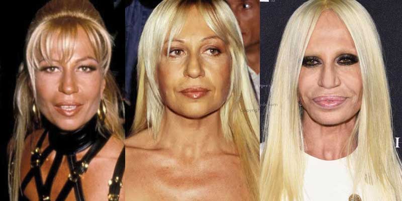 Donatella Versace Plastic Surgery Before and After Pictures 2020.