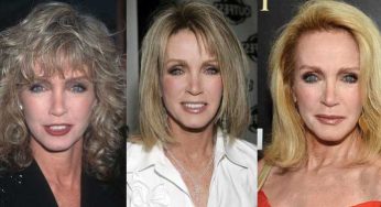 Donna Mills Plastic Surgery