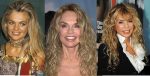 Dyan Cannon Plastic Surgery