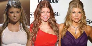 fergie plastic surgery