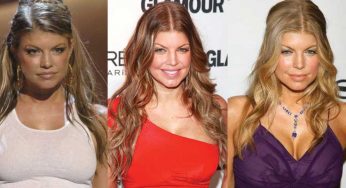 Fergie Plastic Surgery