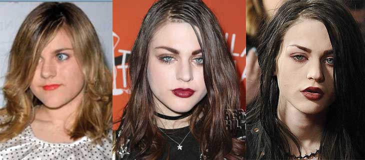 Frances Bean Cobain Plastic Surgery Before and After 2023