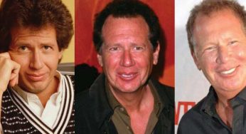 Garry Shandling Plastic Surgery