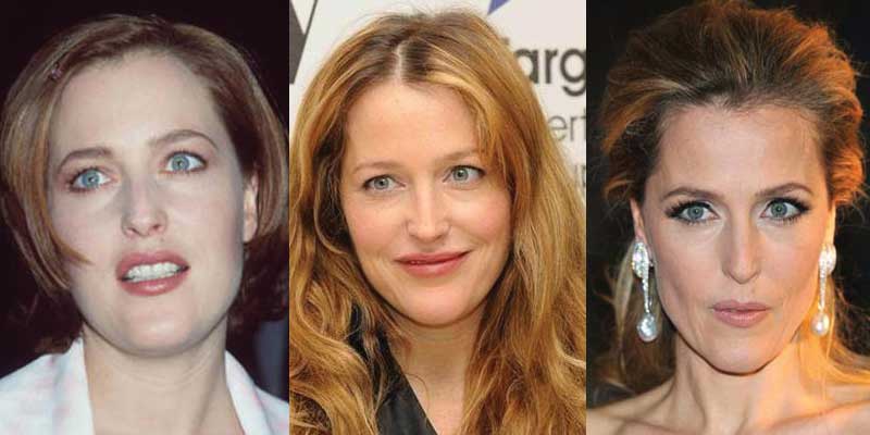 Gillian Anderson Plastic Surgery Before and After 2022