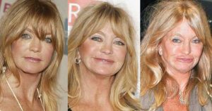 goldie hawn plastic surgery