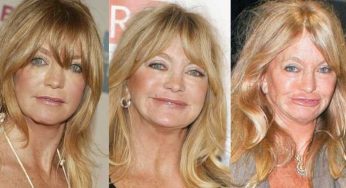 Goldie Hawn Plastic Surgery