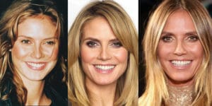 heidi klum plastic surgery