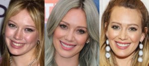 hillary duff plastic surgery