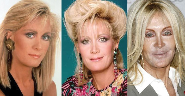 Joan Van Ark Plastic Surgery Before and After 2022