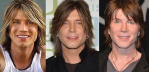 john rzeznik plastic surgery