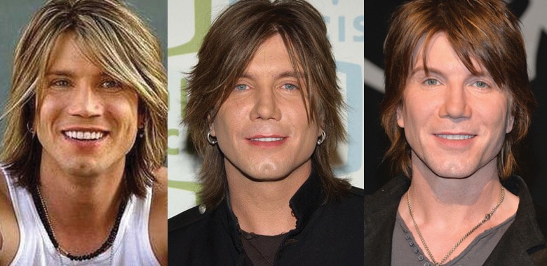 John Rzeznik Plastic Surgery Before and After 2022