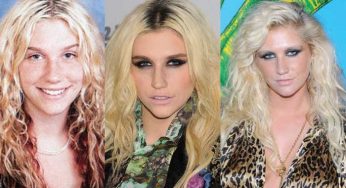 Kesha Plastic Surgery