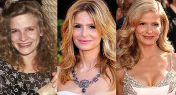Kyra Sedgwick Plastic Surgery
