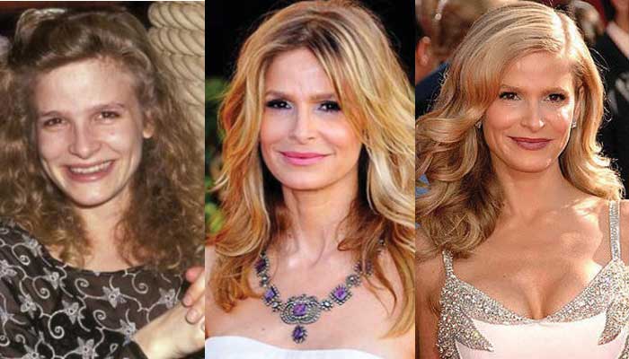 kyra sedgwick plastic surgery