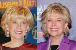 Leslie Stahl Plastic Surgery