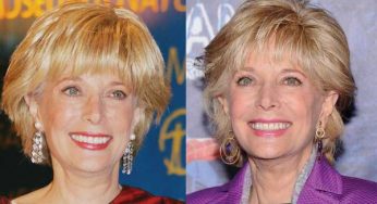Leslie Stahl Plastic Surgery