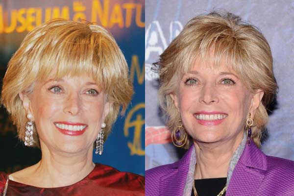 leslie stahl plastic surgery