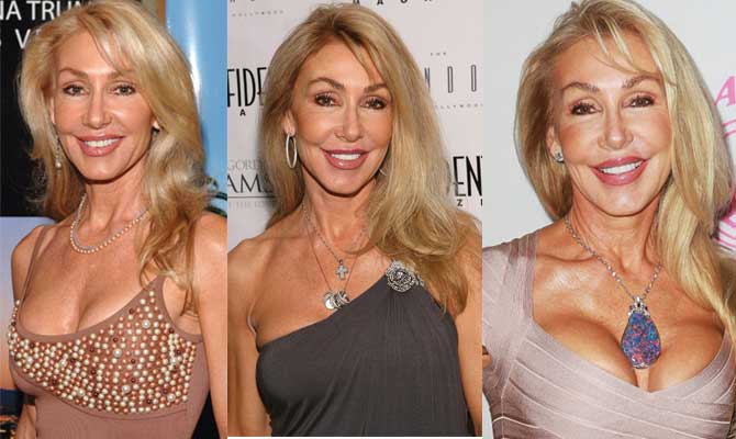 linda thompson plastic surgery