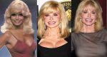 Loni Anderson Plastic Surgery