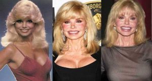 loni anderson plastic surgery