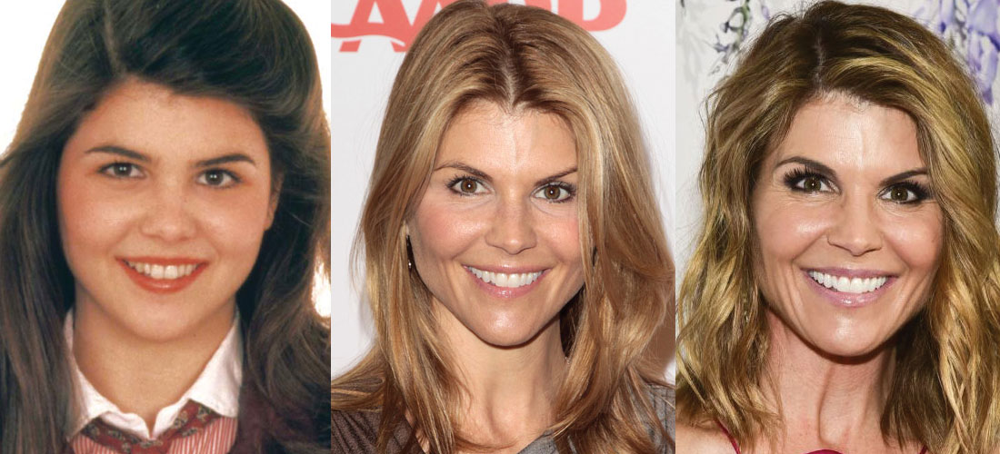 Lori Loughlin Plastic Surgery Before and After 2023