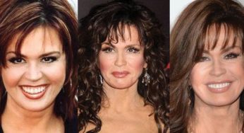 Marie Osmond Plastic Surgery