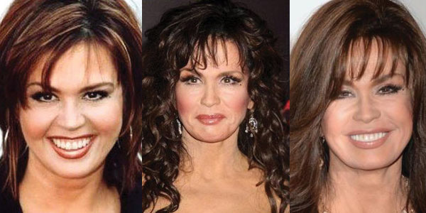 marie osmond plastic surgery