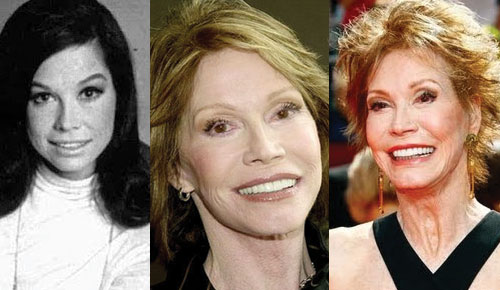 mary tyler moore plastic surgery