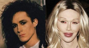 Pete Burns Plastic Surgery