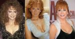 Reba Mcentire Plastic Surgery