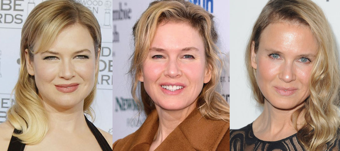 Renee Zellweger Plastic Surgery Before and After 2022