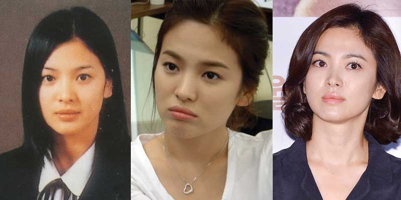 song he kyo plastic surgery