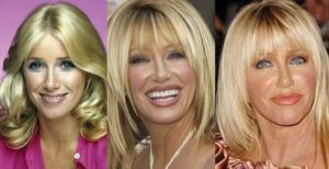 suzanne somers plastic surgery