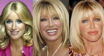 Suzanne Somers Plastic Surgery