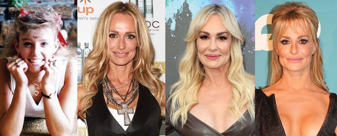 Taylor Armstrong Plastic Surgery Before and After 2024