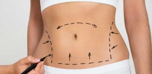 tummy tuck surgery cost in usa